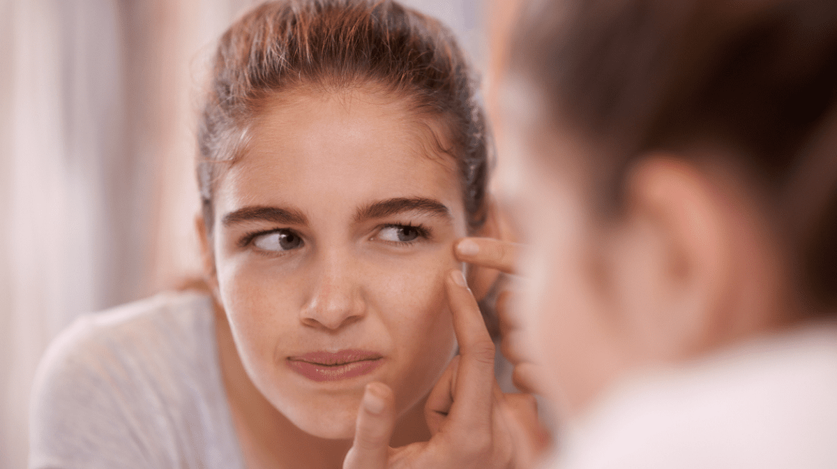 How To Care For Blemish Prone Skin