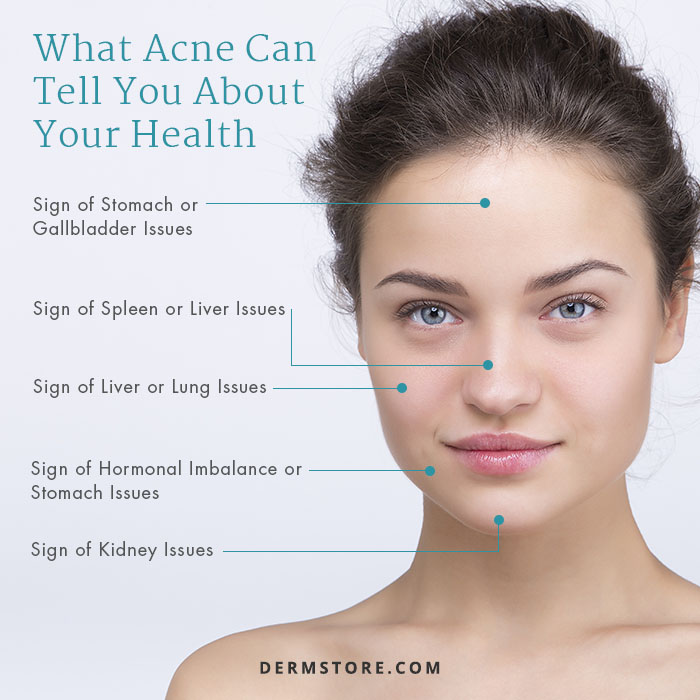face map acne I Dermstore Blog
