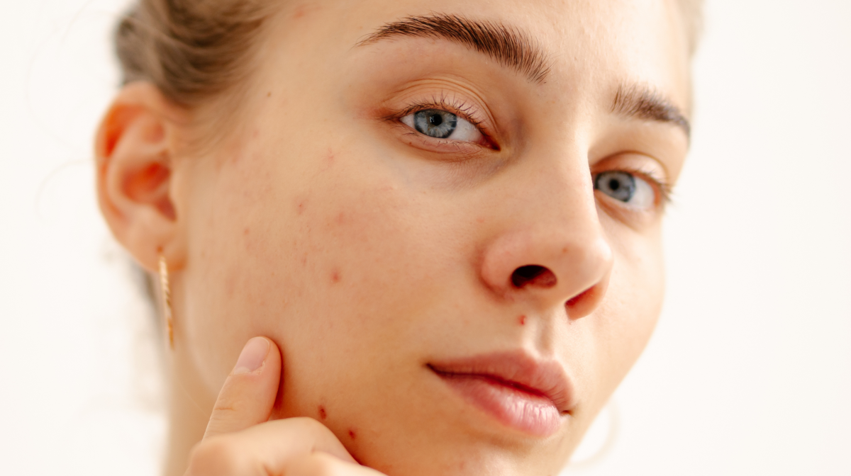 Glycolic Acid for Acne Scars