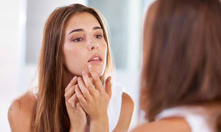 What Your Acne Might Be Telling You About Your Health