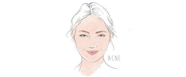 acne drawing