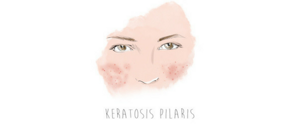 keratosis pilaris