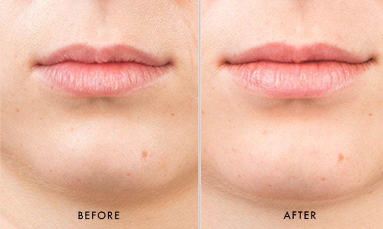 how to get rid of lip lines permanently