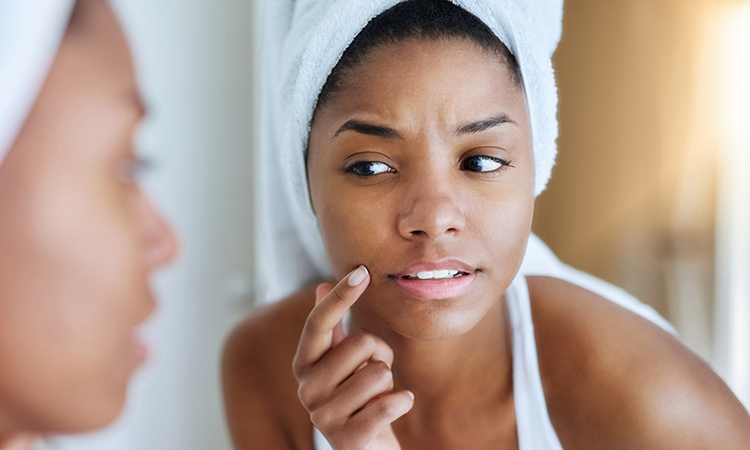 How to Diagnose Your Specific Type of Acne and Treat It Properly