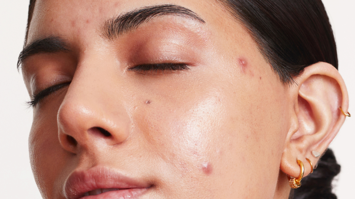 Best Skincare Routine for Acne