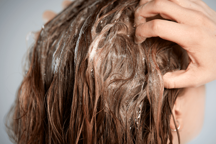 How to get rid of Minoxidil Flakes | HairMD, Pune