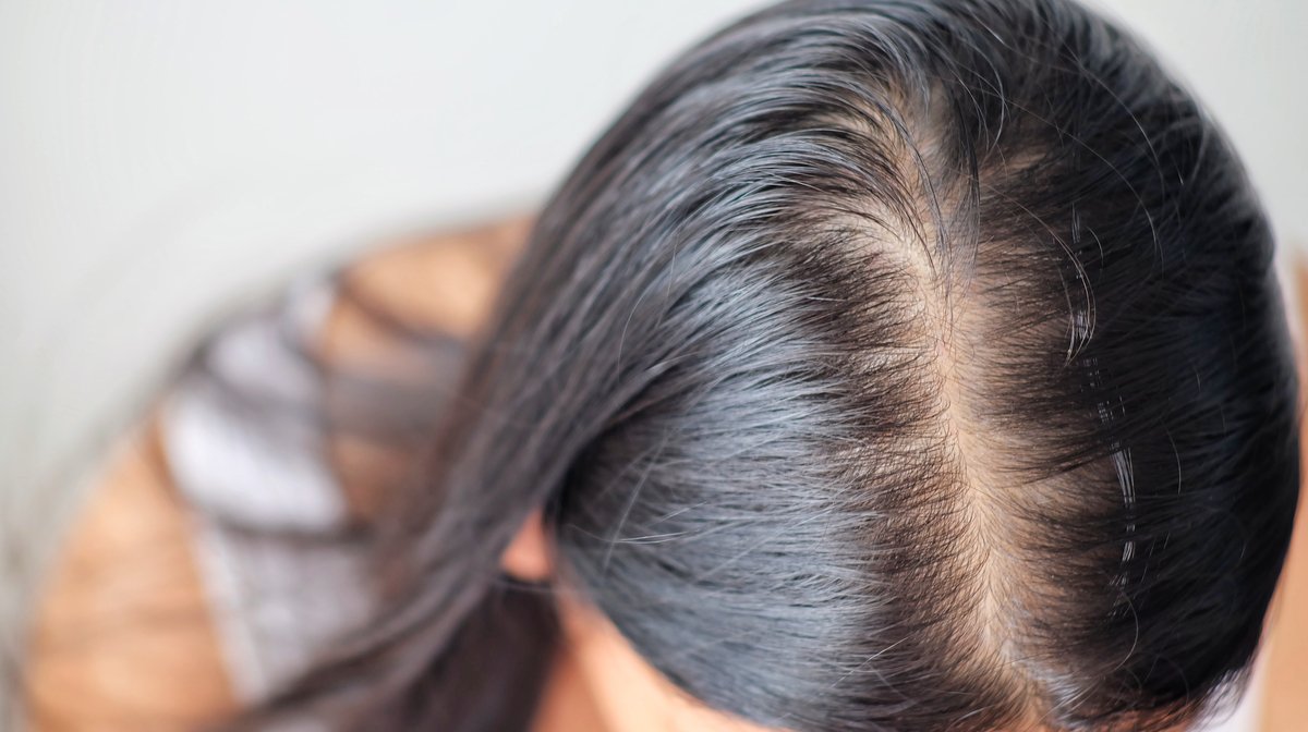 Thyroid related hair loss