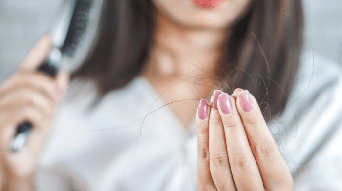 What Is PCOS Hair Loss?