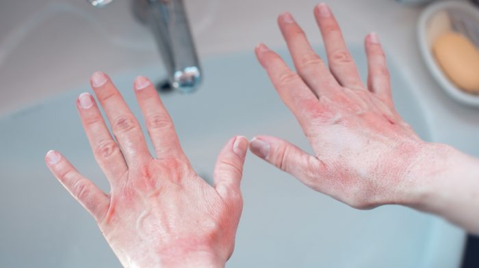 hands with eczema