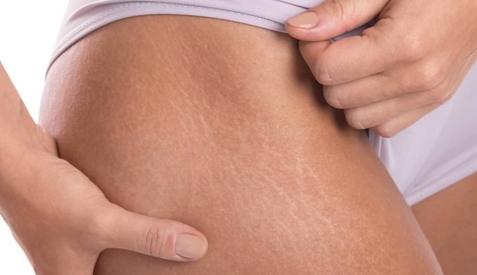 Vitamin E for Scars and Stretch Marks