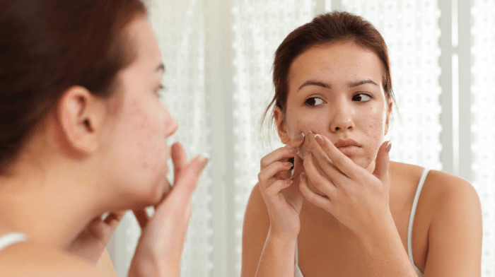 8 Ingredients That Can Fade Blemishes