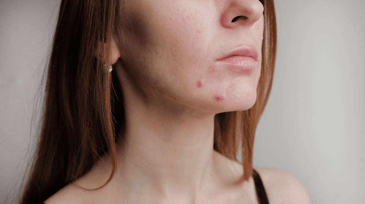 Summer breakouts explained