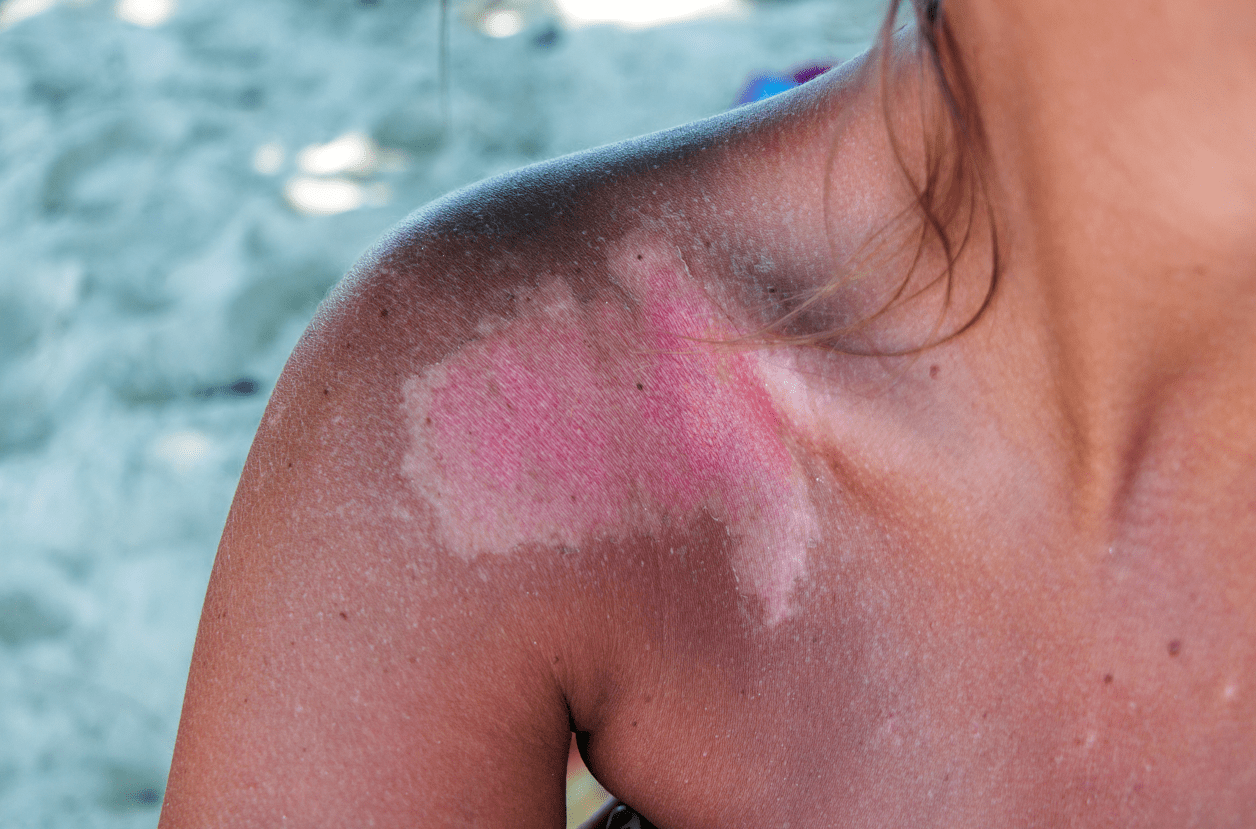 sunburn summer skincare