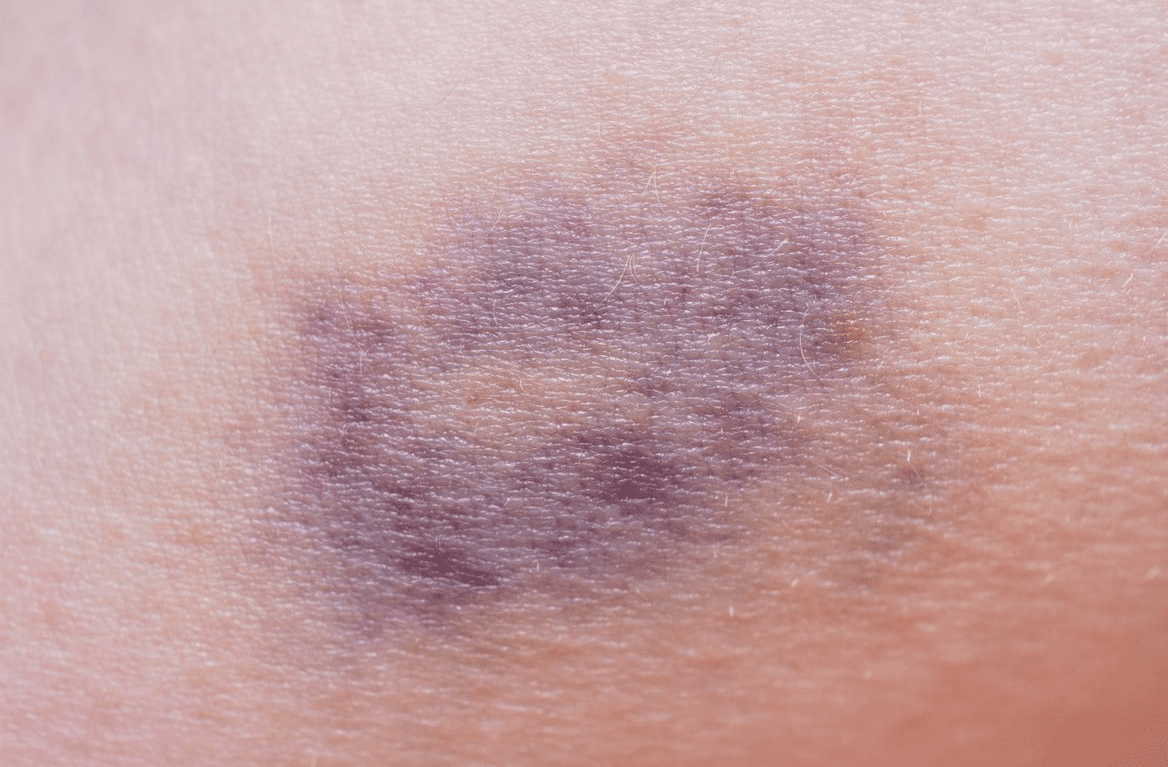 Bruises summer skin 
