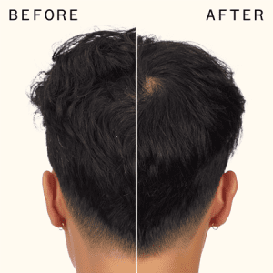 how-to-treat-dry-scalp