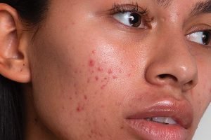 model with acne on her cheeks