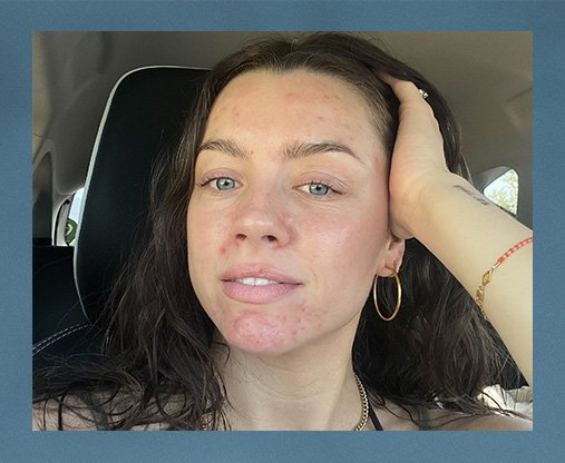 A selfie of Maddie Edwards, a white female with brown hair, taken in her car. she is barefaced with no mnake up on, proudly displaying her skin.