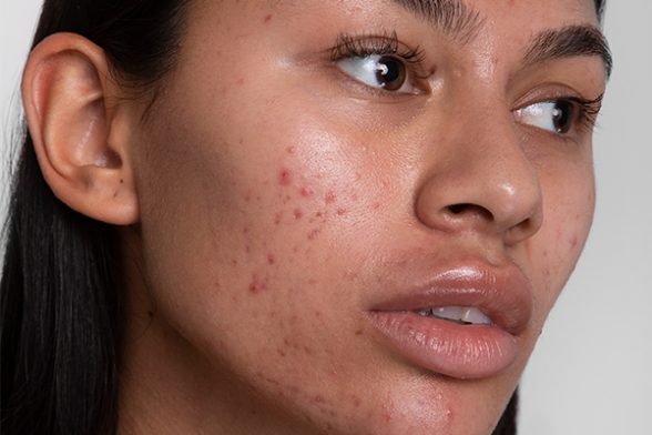 How to tackle scars and pigmentation