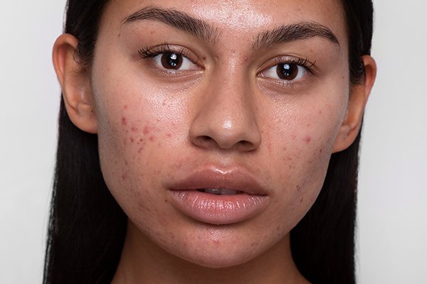 Ask Cult Concierge: The Best Skin Care Routine for Blemish-Prone Skin