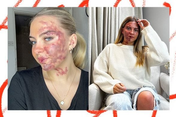 two images of nancy morel, one a selfie with her skin flare up in full view and the other of her sitting on a sofa wearing a white jumper and jeans