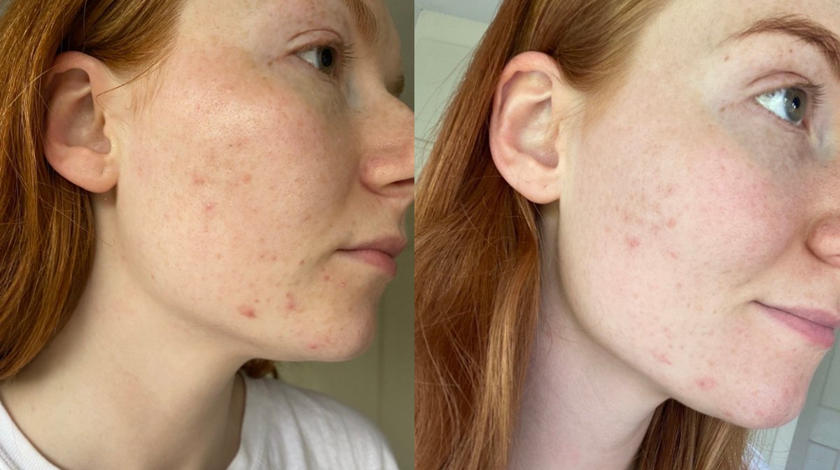 Nuværende en gang Twisted We used blue light therapy for a month and here are the results |  LOOKFANTASTIC Blog