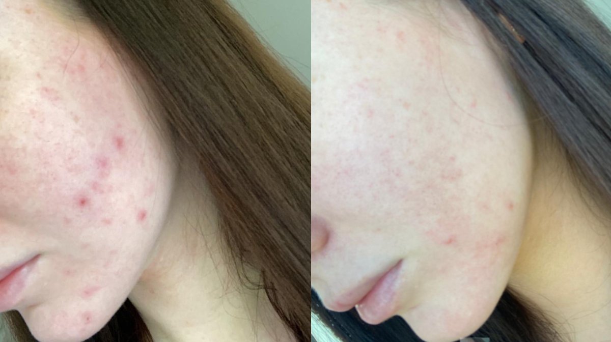 We used blue light therapy for a month and here are the results LOOKFANTASTIC Blog