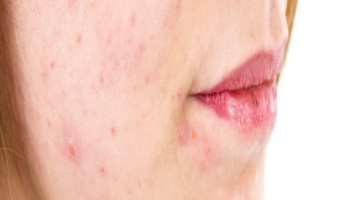Acne Scars: Heal Your Skin Safely And Effectively | allbeauty Blog