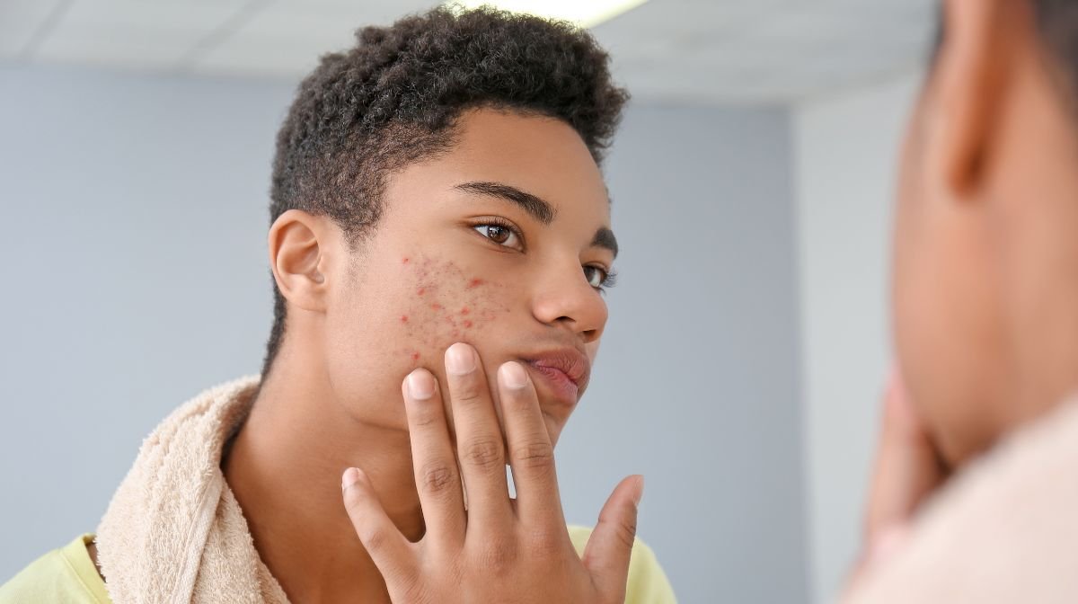 How to treat hormonal acne