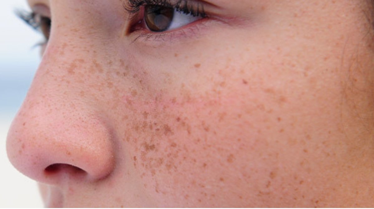 Freckles: Friend or Foe?