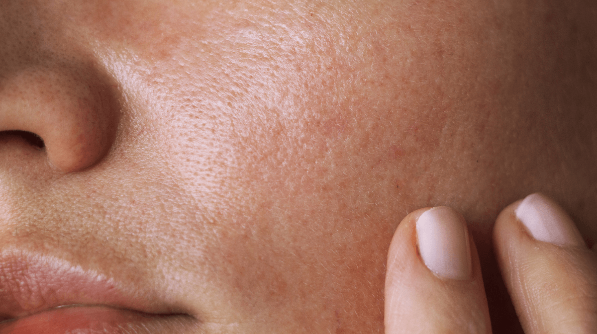 How to Reduce Hyperpigmentation