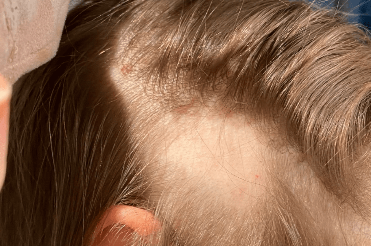 What is the Difference Between Alopecia Areata and Tinea Capitis  Compare  the Difference Between Similar Terms