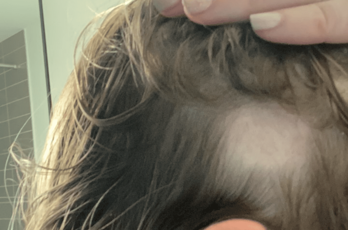Kayleigh Dowling's Alopecia hair loss