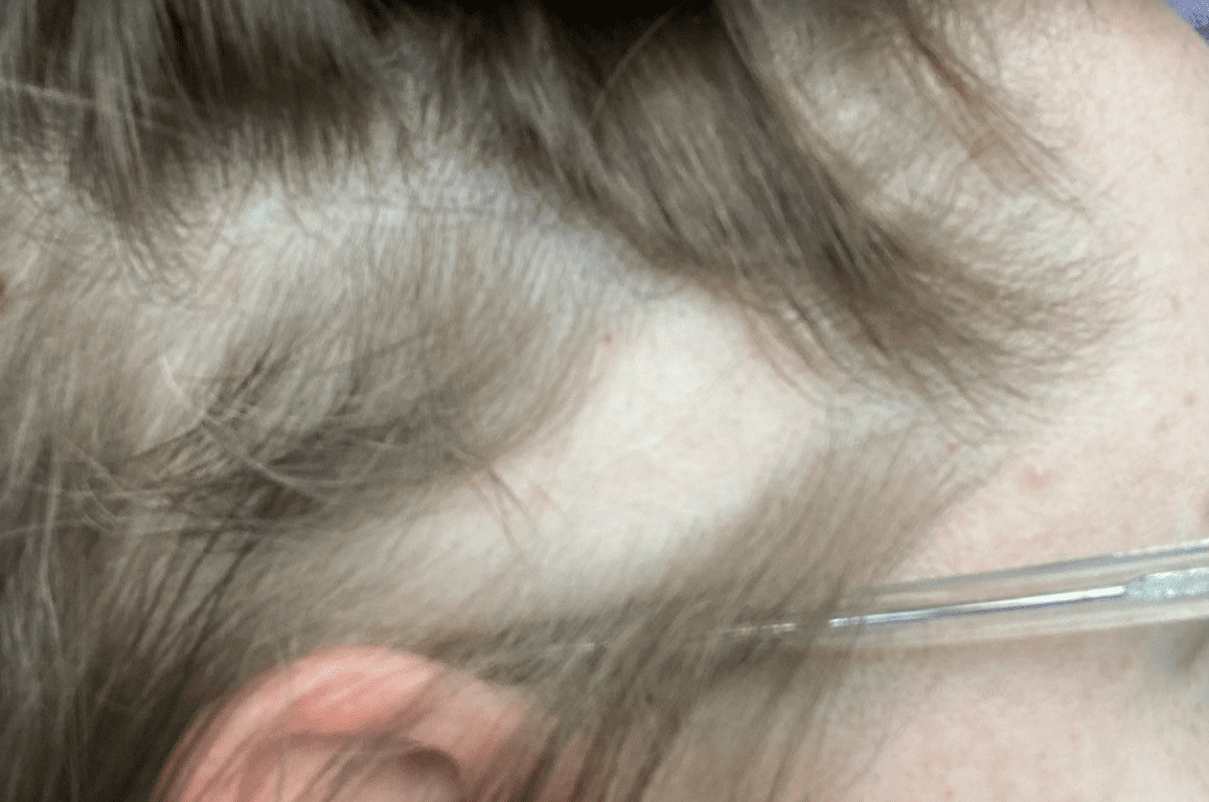 Kayleigh Dowling's Alopecia hair loss