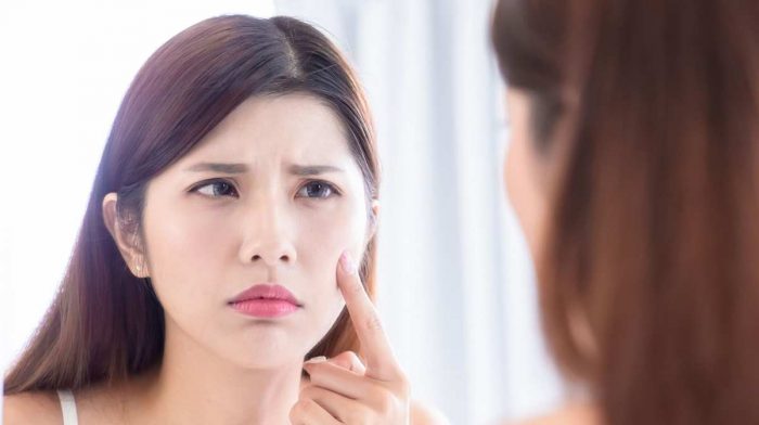 How to Get Rid of Blackheads