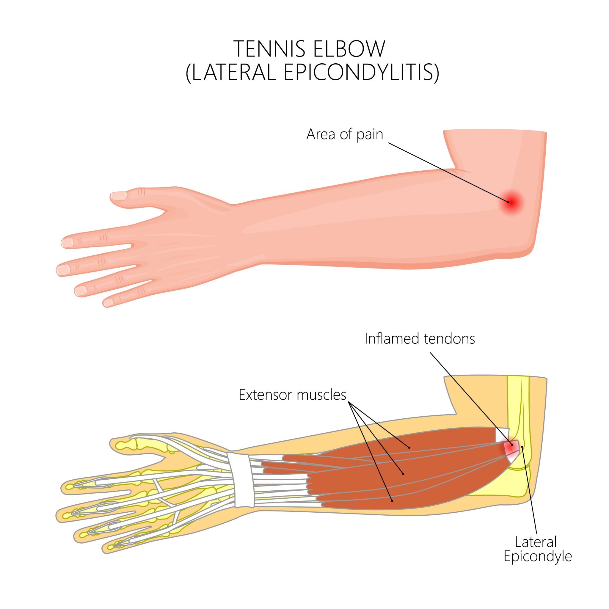 Tennis & Golfers Elbow Exercises & Treatment MYPROTEIN™