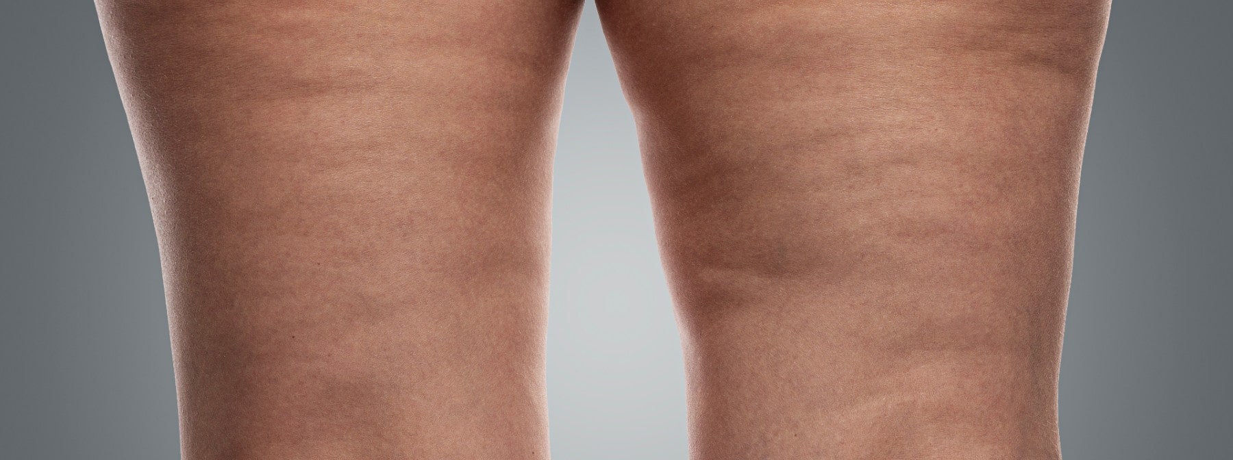 Getting “Rid” Of Cellulite: Science Fact Or Fiction
