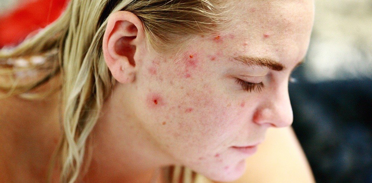 how to beat adult acne