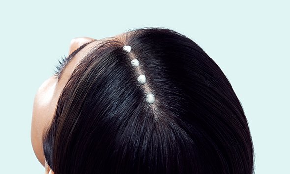 dry scalp treatment