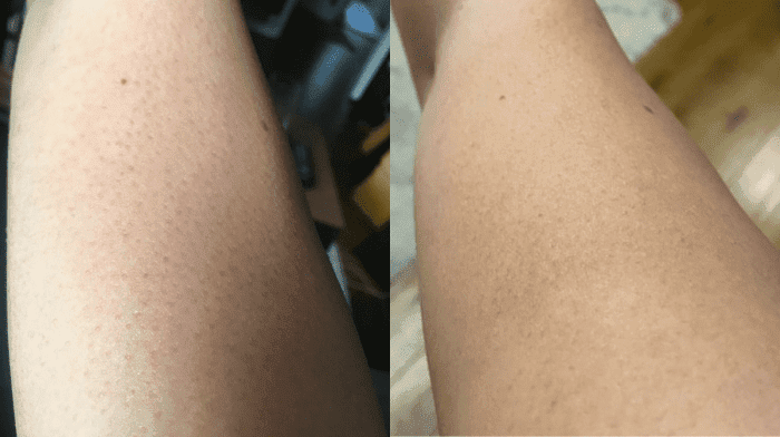 How I Got Rid Of The Bumps On My Upper Arms | Testimonial
