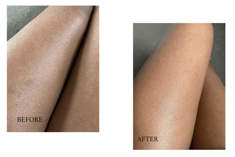 before and after images of ingrown hairs on legs