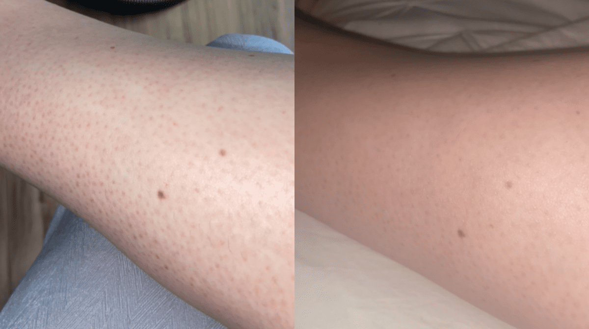 How I Treated The Bumps On My Legs | Testimonial