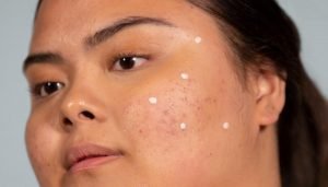 blemished face with spot treatment