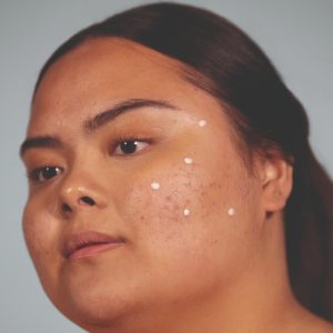 woman with spot cream on face