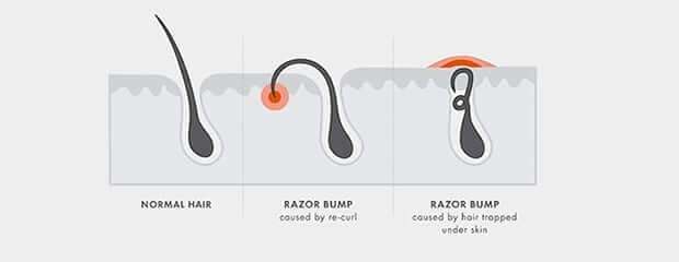 razor bumps illustration