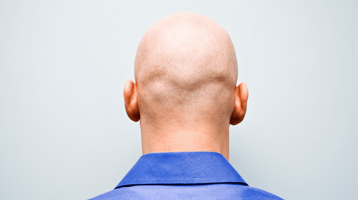Back of bald man’s head 