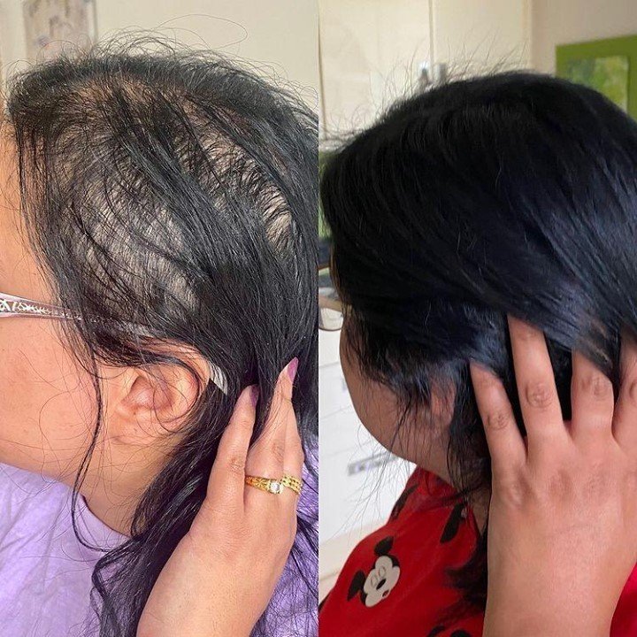 TikTokers show off hair growth after starting miracle alopecia drug See  the before and after