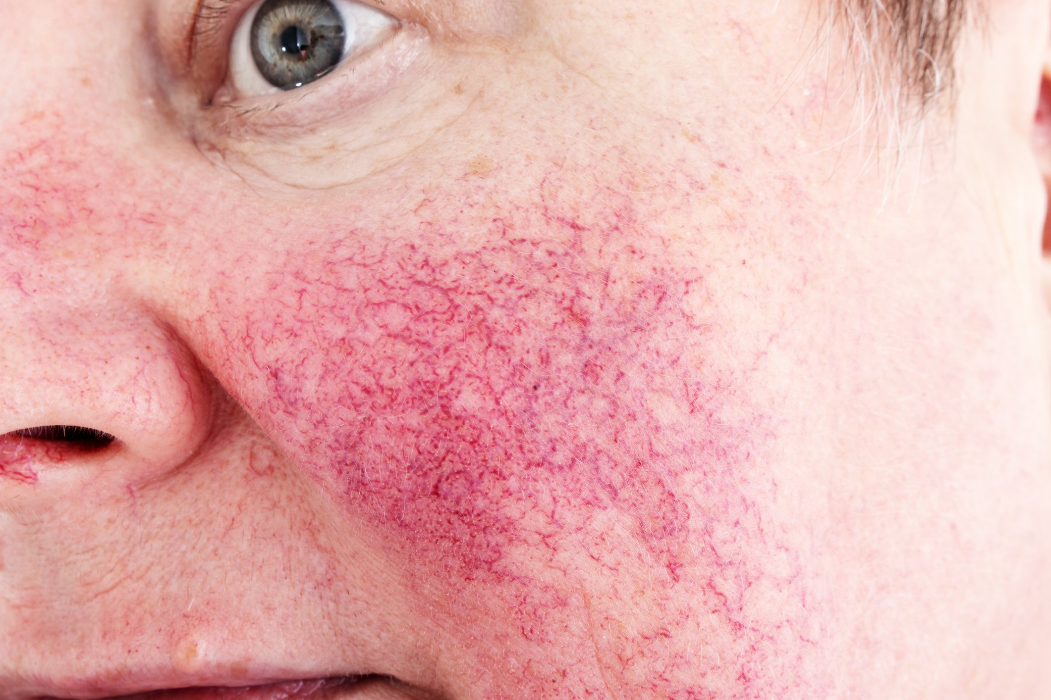 How to Help treat Rosacea with No7