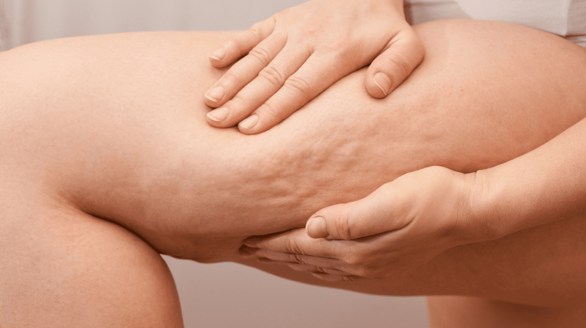 woman pinching leg to show cellulite