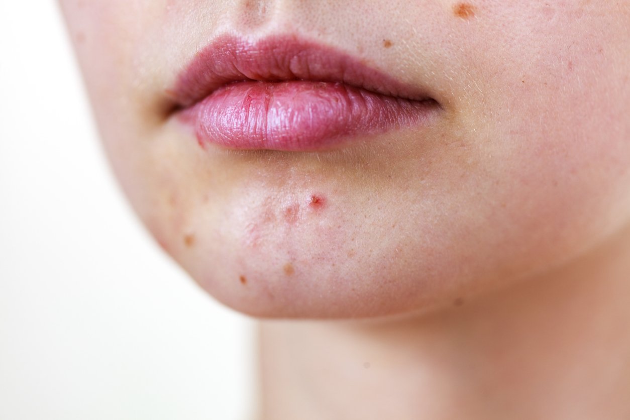 Female face with acne skin problem