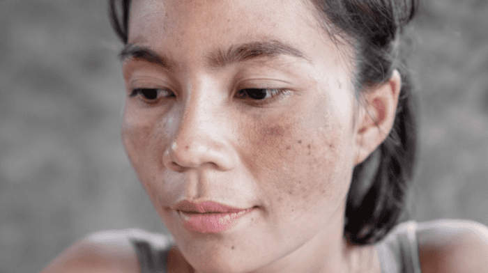 Everything You Need to Know About Hyperpigmentation of the Skin